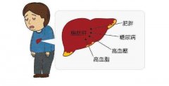脂肪肝別陷入6個(gè)誤區